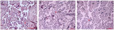 RNA-seq analysis-based study on the effects of gestational diabetes mellitus on macrosomia